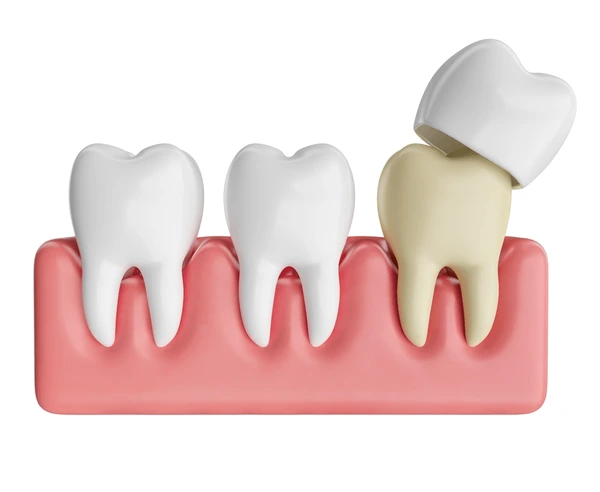 dental-crown