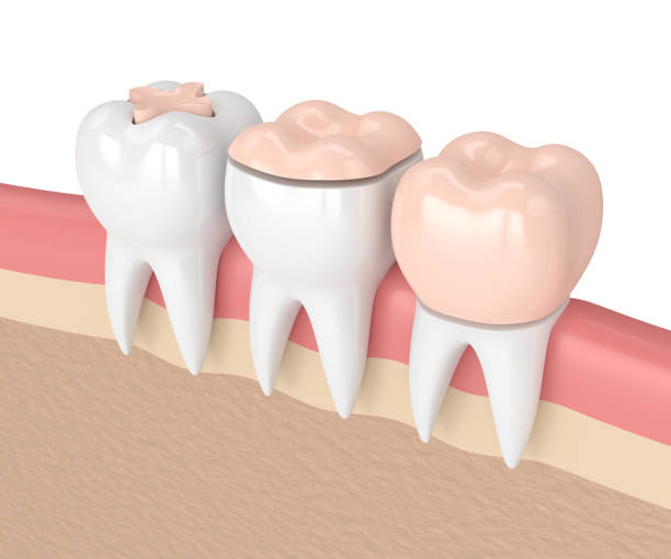 dental-inlay